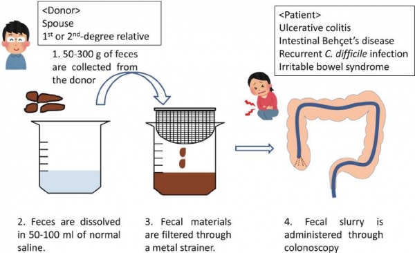 Fecal microbial transfer (Fecal transplantation) in children?
